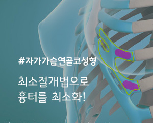 자가가슴연골코성형